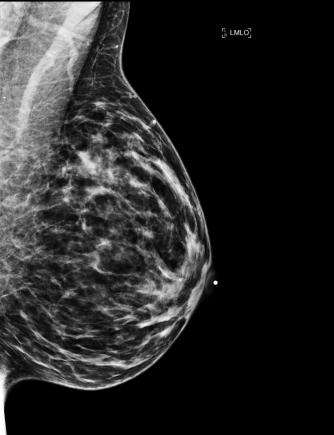 Mamorgrafie performantă, indicată pacientelor cu predispoziție la cancerul mamar