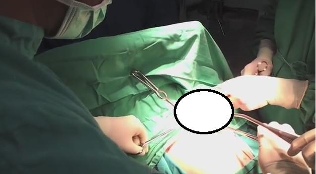 Medicii au salvat viaţa unei fetiţe de 5 ani, după ce i-au scos din stomac un ghem ENORM de păr