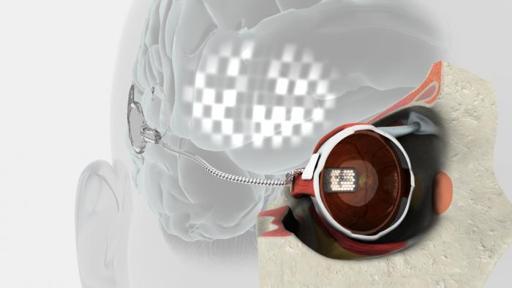 Ochiul bionic, implantat unui  pacient în vârstă de 80 de ani