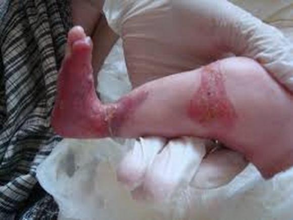 SÃRÃCIE SAU ȊNDOBITOCIRE? Un bebeluş a ajuns la spital doar piele și os, plin de ciupituri de purici 