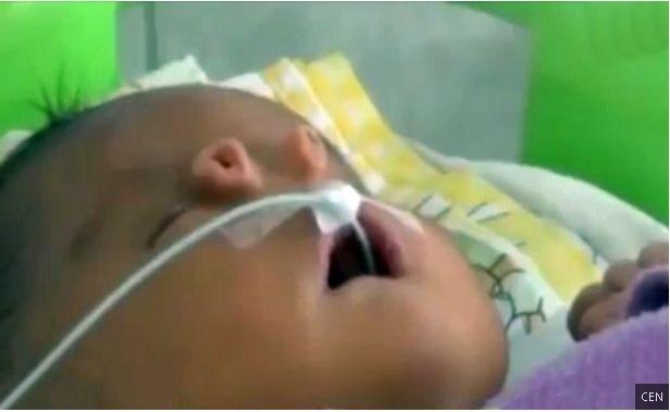 Un bebeluș s-a născut cu DOUĂ NASURI. Micuțul suferă de o boală genetică extrem de rară (VIDEO)