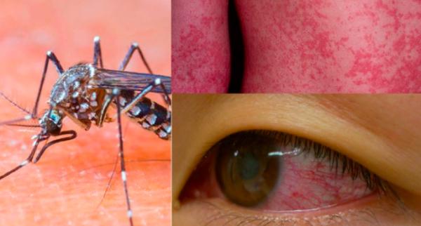 Virusul Zika: Sângerări, leziuni oculare şi chiar pierderea vederii la bebeluşi!   
