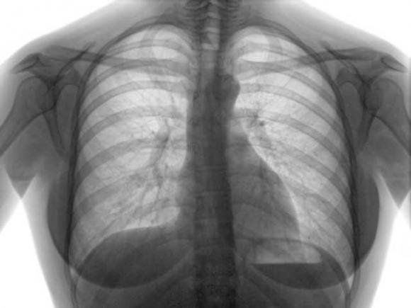 OMS: Tuberculoza, o amenințare pentru omenire!