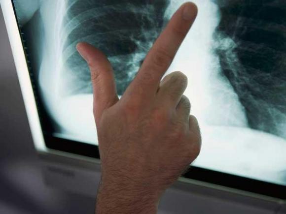 Tuberculoza ameninţă din nou Europa