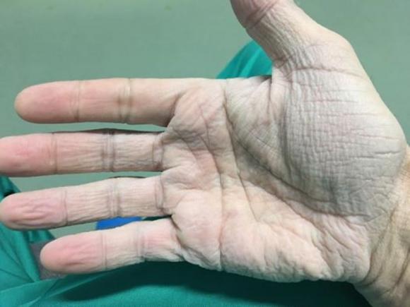 Cardiologul Horea Feier:  Așa arată ”mâna dreaptă, după 12 ore de operații la 30 de grade”