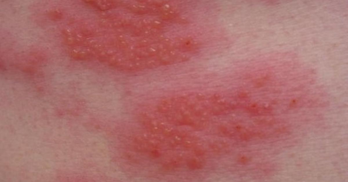 Ajutor în caz de eczemă atopică | Dermatita atopică | oldones.ro