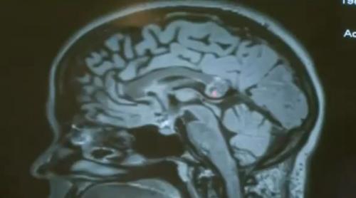 Caz șocant: Embrion uman, descoperit în creierul unei femei! (VIDEO)