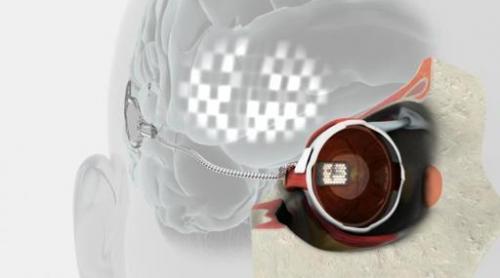 Ochiul bionic, implantat unui  pacient în vârstă de 80 de ani