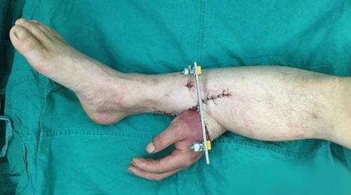 Medicii chinezi au realizat o operaţie surprinzătoare: au grefat o mână pe un picior 