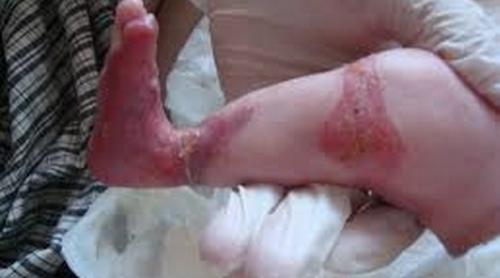 SÃRÃCIE SAU ȊNDOBITOCIRE? Un bebeluş a ajuns la spital doar piele și os, plin de ciupituri de purici 