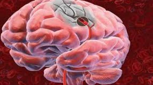 Pentru salvarea neuronilor, în curând, un marker care evaluează riscul de accident vascular cerebral
