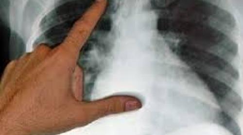 OMS: Anul trecut, tuberculoza a provocat 1,1 milioane de decese, la fel ca SIDA