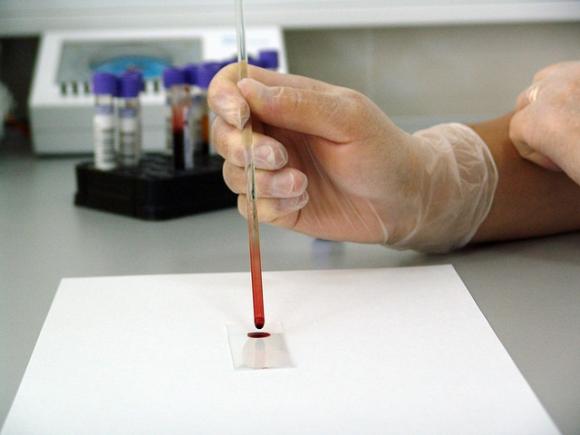 O substanţă prezentă în organismul femeii ar putea contribui la depistarea precoce a cancerului de sân O substanţă prezentă în organismul femeii ar putea contribui la depistarea precoce a cancerului de sân