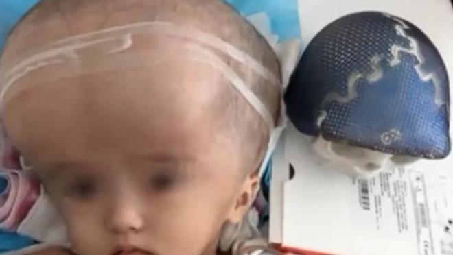 Unei fetiţe din China i s-a implantat un craniu realizat prin tehnica 3D