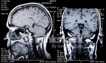 O nouă tehnologie imagistică pentru depistarea maladiei Alzheimer O nouă tehnologie imagistică pentru depistarea maladiei Alzheimer