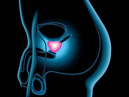 Au fost identificate cinci tipuri diferite de cancer de prostată