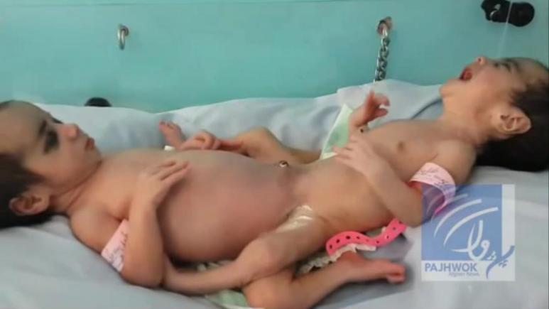 Siameze, unite în zona abdomenului şi genitală, separate într-un spital din Kabul (VIDEO) Siameze, unite în zona abdomenului şi genitală, separate într-un spital din Kabul (VIDEO)