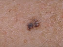  Imunoterapia în melanomul cu metastaze stopează evoluţia bolii şi măreşte rata de supravieţuire 