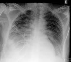 Pneumonia: Vârsta, un factor de risc