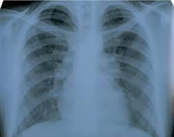 Focar TB la o şcoală din Galaţi: Până acum, 4 cazuri spitalizate şi toţi elevi fac tratament preventiv