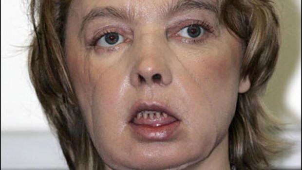  Isabelle Dinoire, prima femeie cu transplant de față,a decedat 
