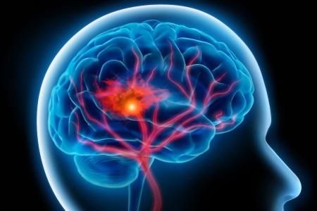 Atac cerebral: Cheagul de sânge este aspirat în 20-60 de minute 