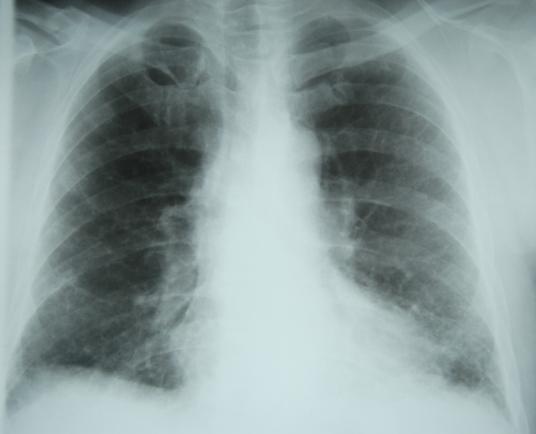 Fibroza pulmonară idiopatică, o boală versatilă și misterioasă 
