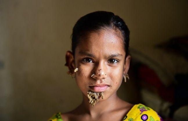 Bangladesh: Posibil, primul caz din lume de femeia-copac!