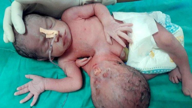 Bebelușul, venit pe lume cu un al doilea cap, a fost salvat, după o operație extrem de complicată 
