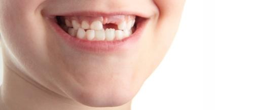 Dinții de lapte: Nu-i aruncați, deoarece conțin celule sușe utile în lupta contra multor boli!