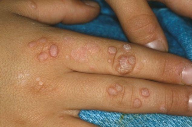 Tradiţii şi superstiţii. Sfaturi băbeşti. Cum scapi de negi cu ajutorul unei broaşte râioase