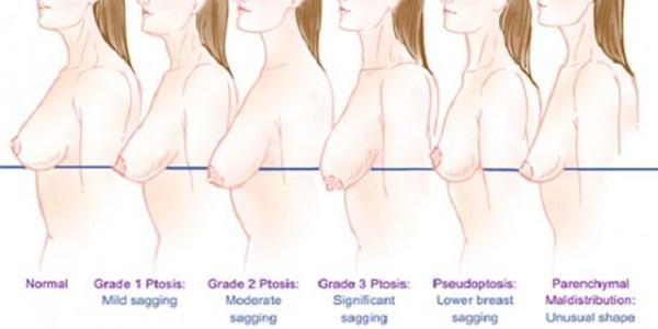 Sâni fermi şi frumoşi! Cinci obiceiuri DE EVITAT dacă vrei să-ţi menţii bustul sănătos