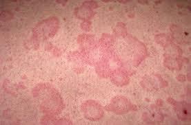 Urticaria afectează 15% din populaţia globului