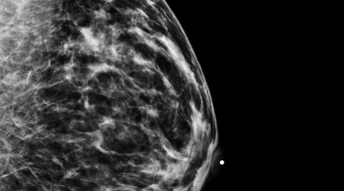 Mamorgrafie performantă, indicată pacientelor cu predispoziție la cancerul mamar