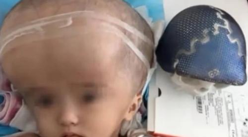 Unei fetiţe din China i s-a implantat un craniu realizat prin tehnica 3D
