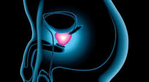 Au fost identificate cinci tipuri diferite de cancer de prostată