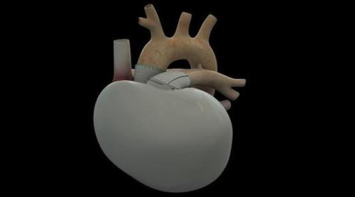 Bilanţ inima artificială Carmat: Doi din trei pacienţi cu implant au decedat