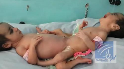 Siameze, unite în zona abdomenului şi genitală, separate într-un spital din Kabul (VIDEO)