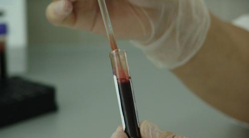 Testul de sânge care poate determina cu 8 luni înainte recidiva cancerului de sân