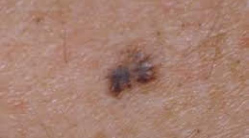  Imunoterapia în melanomul cu metastaze stopează evoluţia bolii şi măreşte rata de supravieţuire 