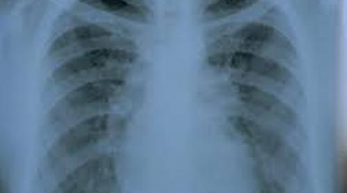Focar TB la o şcoală din Galaţi: Până acum, 4 cazuri spitalizate şi toţi elevi fac tratament preventiv