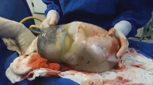 Fenomen: Bebeluș, venit pe lume în sacul amniotic