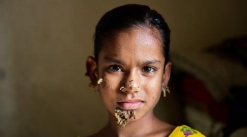 Bangladesh: Posibil, primul caz din lume de femeia-copac!