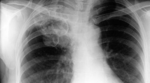 Un nou tratament destinat bolnavilor de tuberculoză multirezistentă la antibiotice 