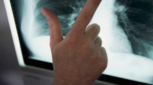 Tuberculoza ameninţă din nou Europa