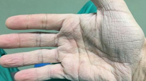Cardiologul Horea Feier:  Așa arată ”mâna dreaptă, după 12 ore de operații la 30 de grade”