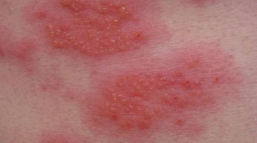Dermatita atopică: Un nou medicament autorizat de Comisia Europeană