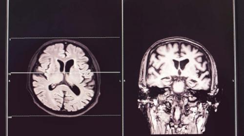 A fost descoperit un nou tip de demenţă, care mimează maladia Alzheimer