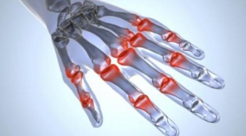 Poliartrita reumatoidă, declanșată de bacterii din cavitatea bucală!