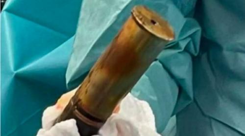 Franța: un bărbat a ajuns la urgențe cu un obuz din Primul Război Mondial înțepenit în rect